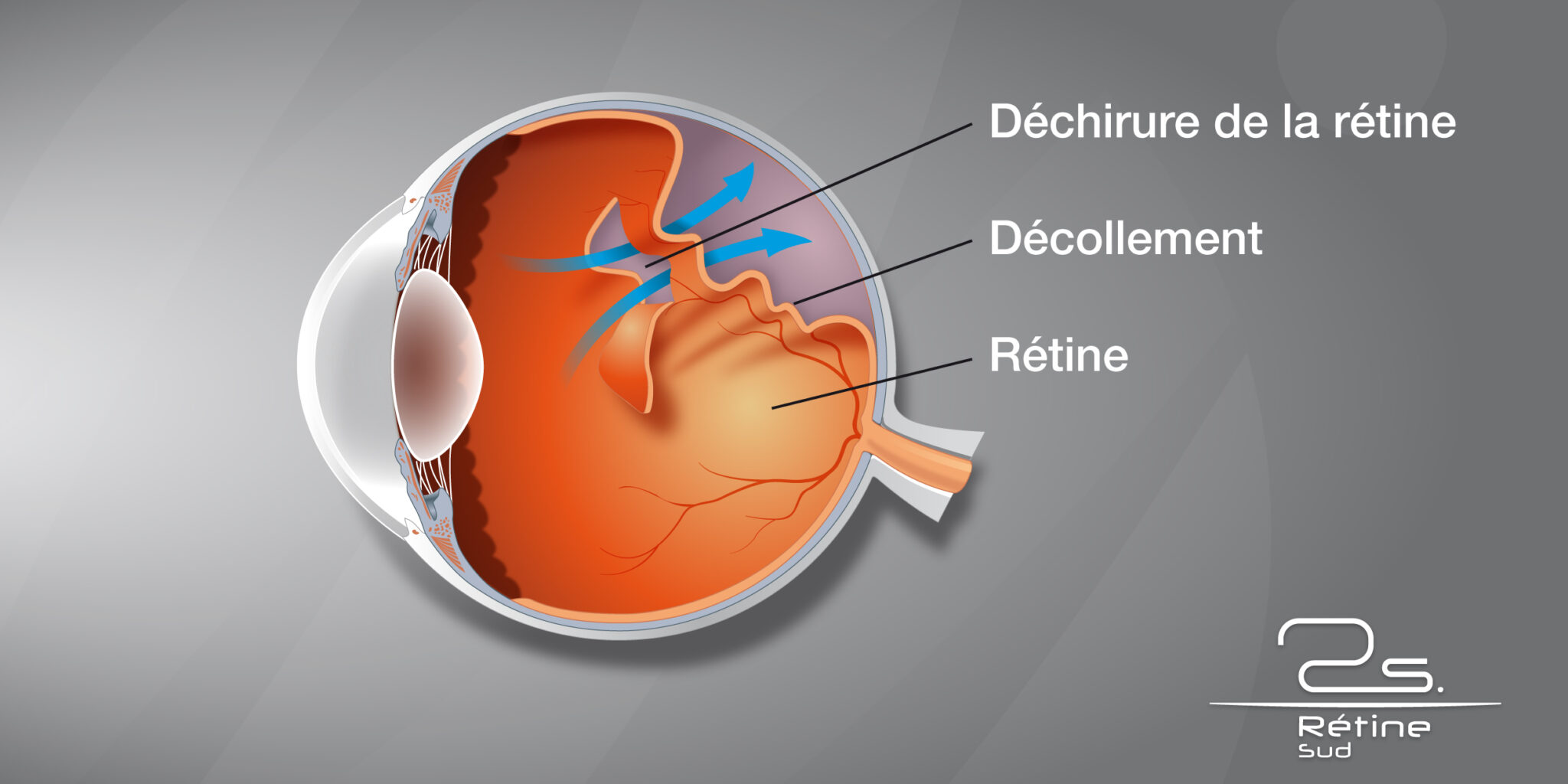 Décollement Du Vitré Et Maux De Tête